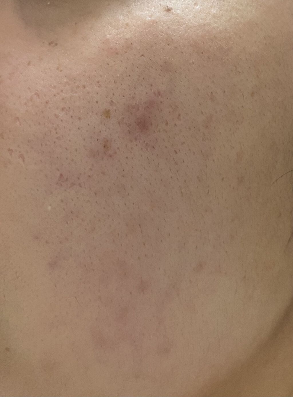 S.S.C. EPI PHOTO SKIN CARE PRO 家庭用光美容器/ミュゼコスメ/美顔器・マッサージを使ったクチコミ（2枚目）