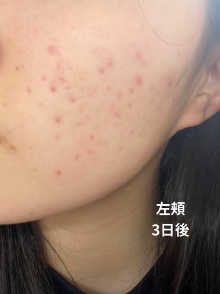 皮脂トラブルケア 保湿ジェル/キュレル/化粧水を使ったクチコミ(5枚目)