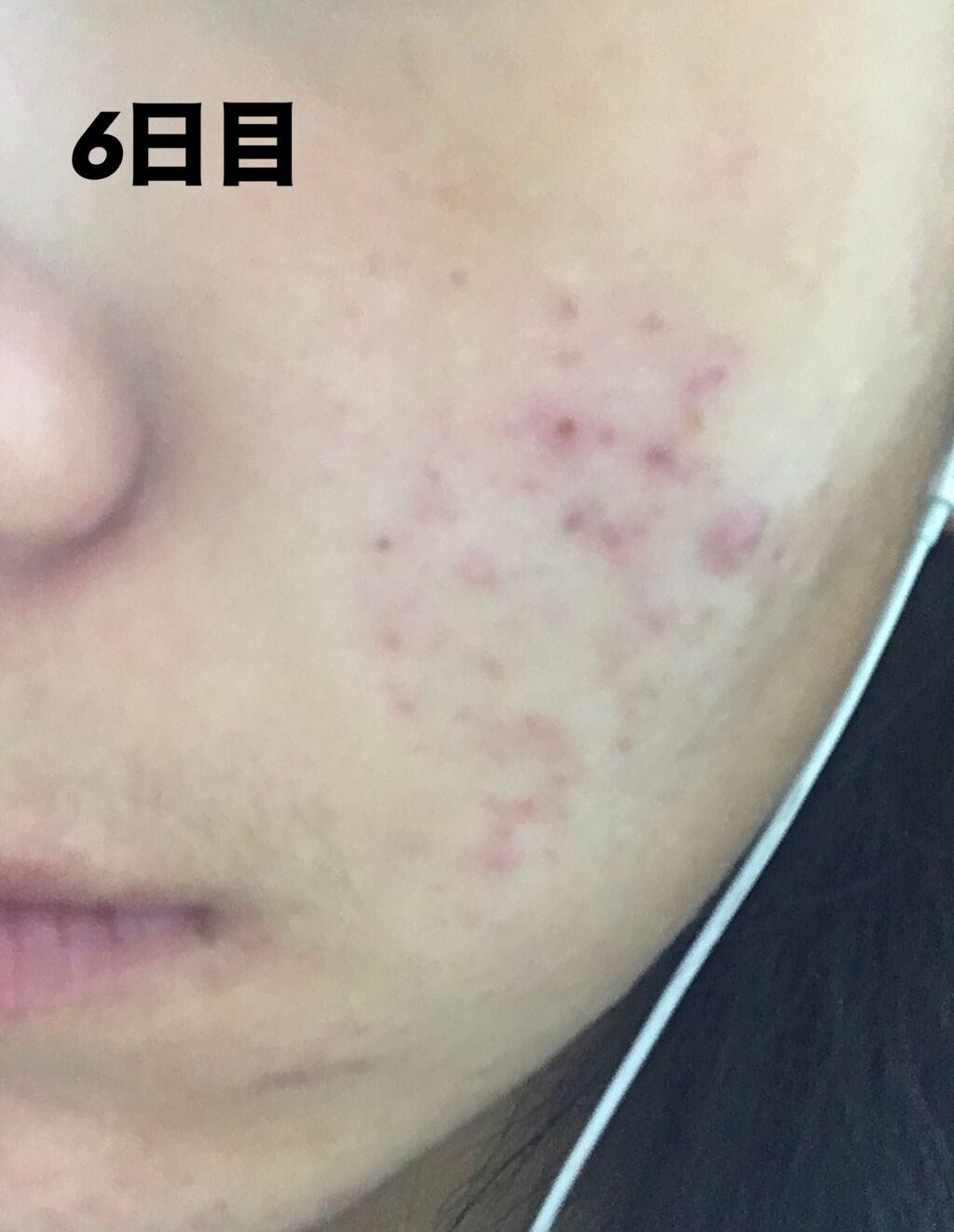 ニキビあとケアジェル/アットノン/その他スキンケアを使ったクチコミ（2枚目）