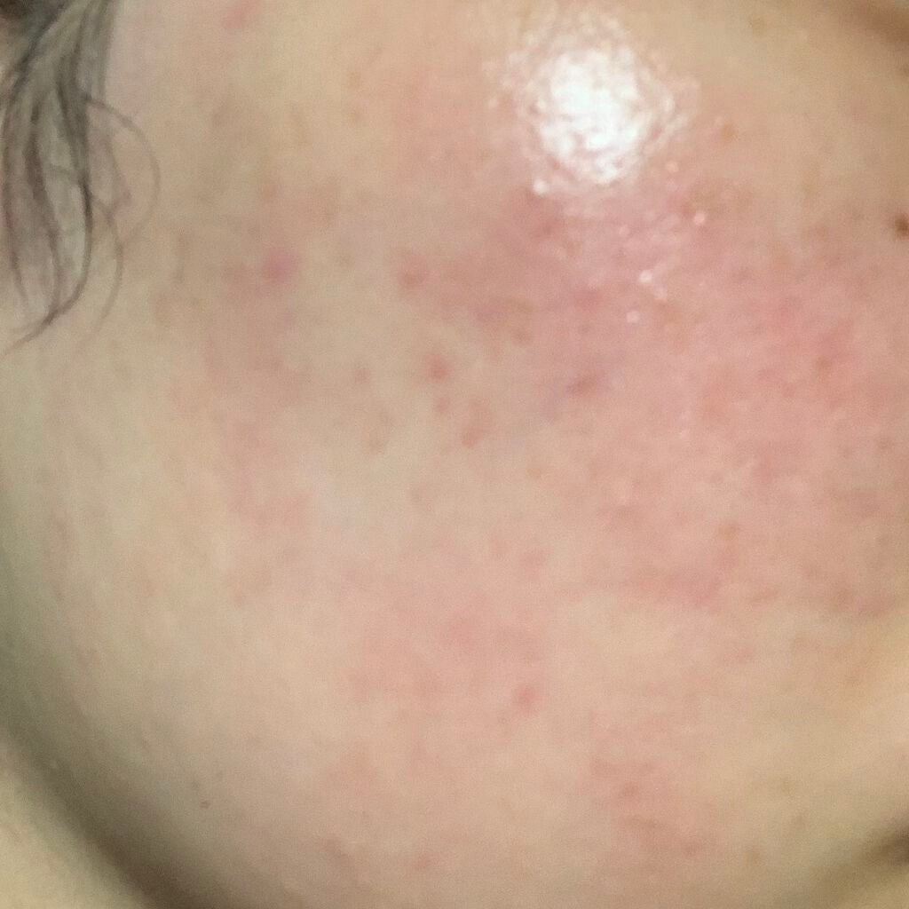 てぃ on LIPS 「助けてください😭😭ニキビ跡が治りません、、メラノCCを使い始め..」(2枚目)