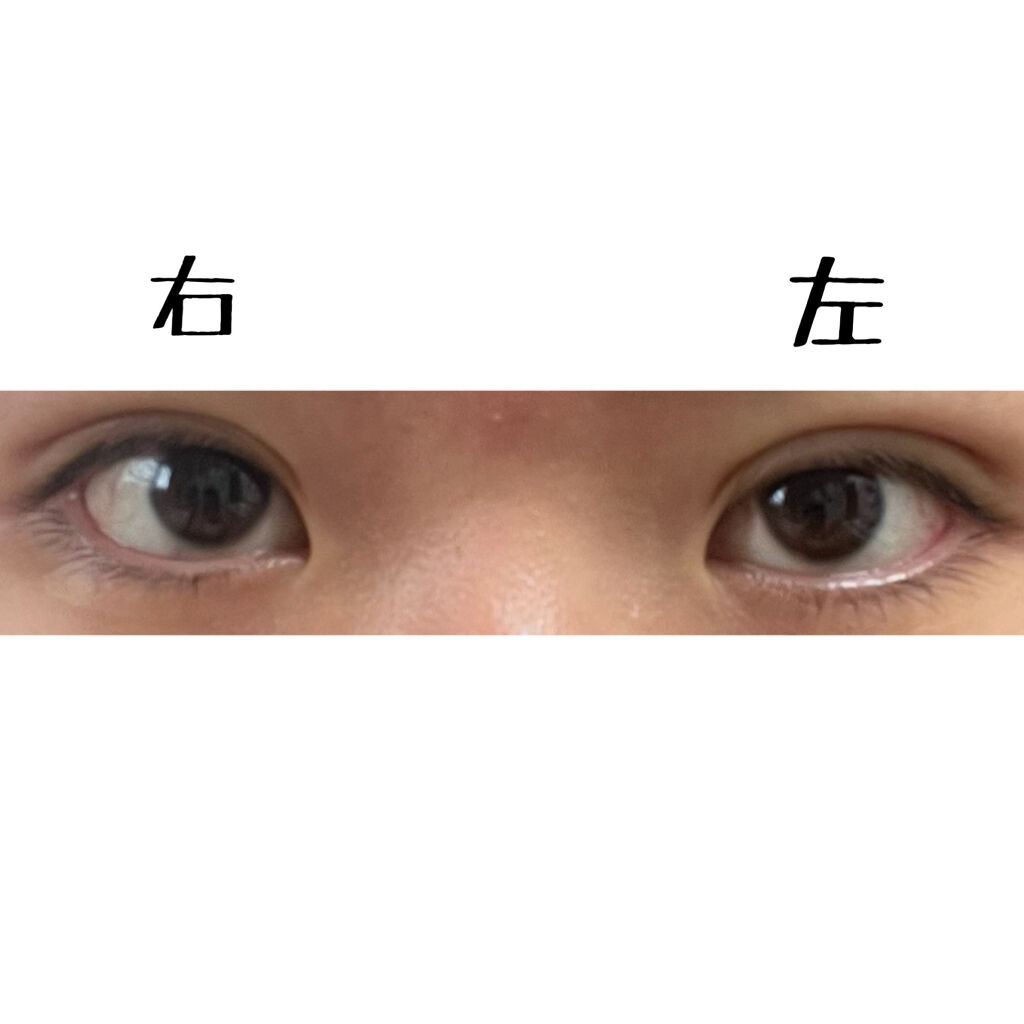 二重整形/その他を使ったクチコミ（3枚目）