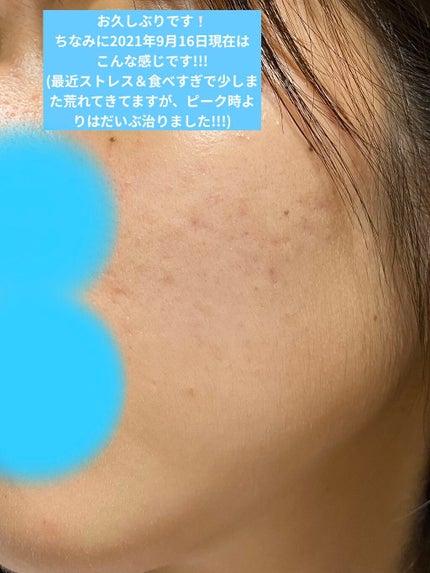 ニキビあとケアジェル/アットノン/その他スキンケアを使ったクチコミ(3枚目)
