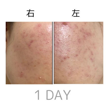 ゼロスポットパッチ/Today’s Cosme/にきびパッチを使ったクチコミ(3枚目)