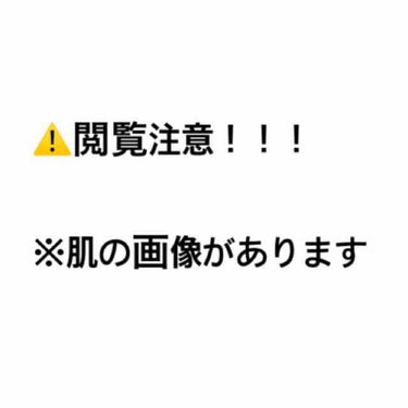 1週間お手入れキット/ルナメアAC/トライアルキットを使ったクチコミ（1枚目）