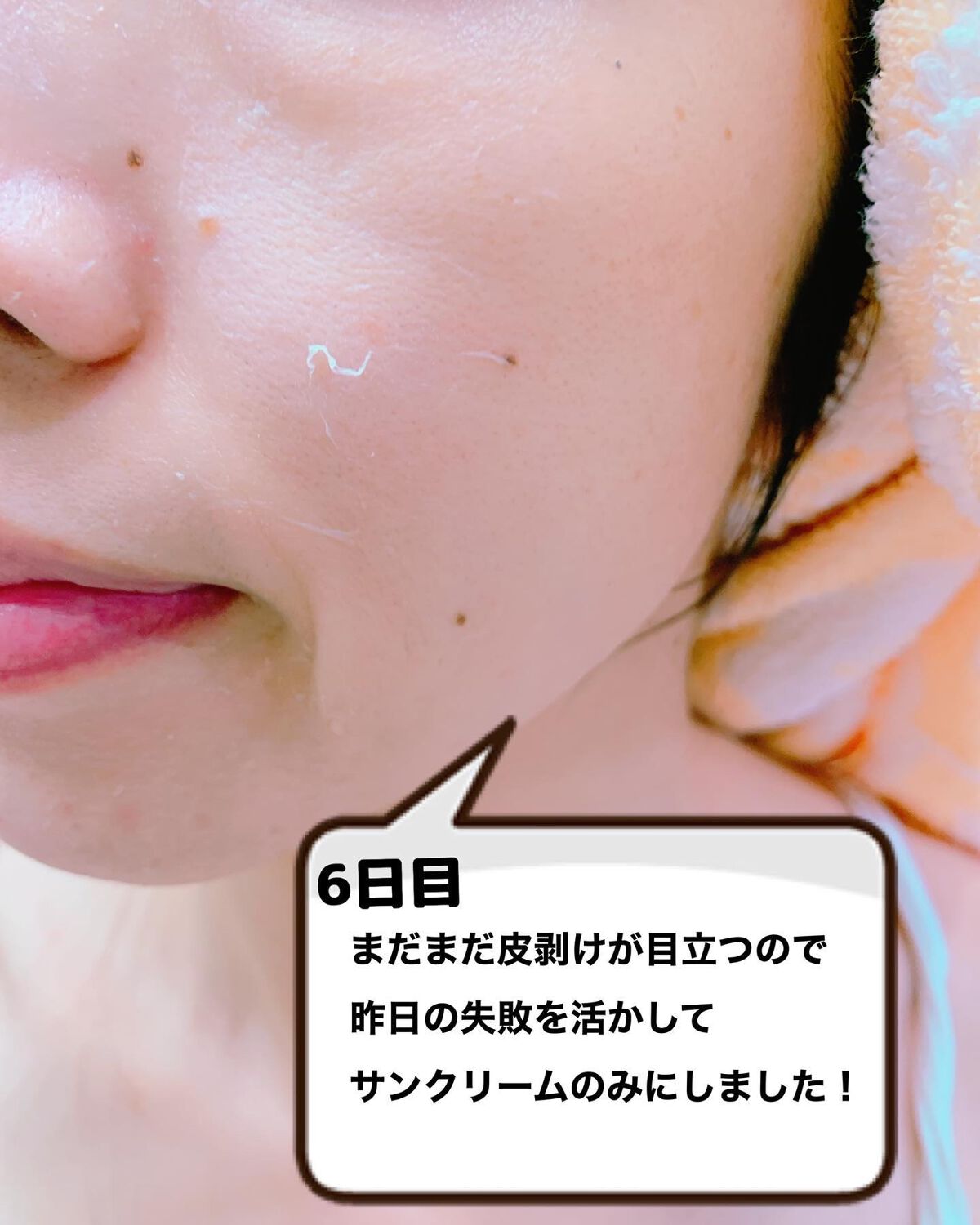 ダーマスキンピーリング|BQCELLの口コミ - * ♡ BQCELL DERMA ダーマスキンピーリング|BQCELLの口コミ - * ♡ BQCELL DERMA