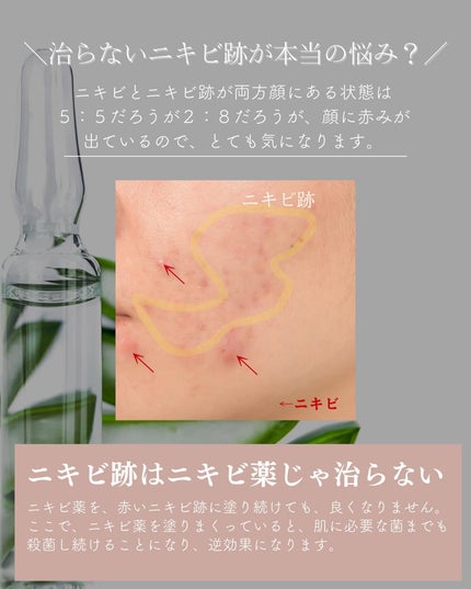 おゆみ|ニキビ・ニキビ跡ケア on LIPS 「@______ohyoume他の投稿はこちらから🖐️❤️おゆみ..」(7枚目)