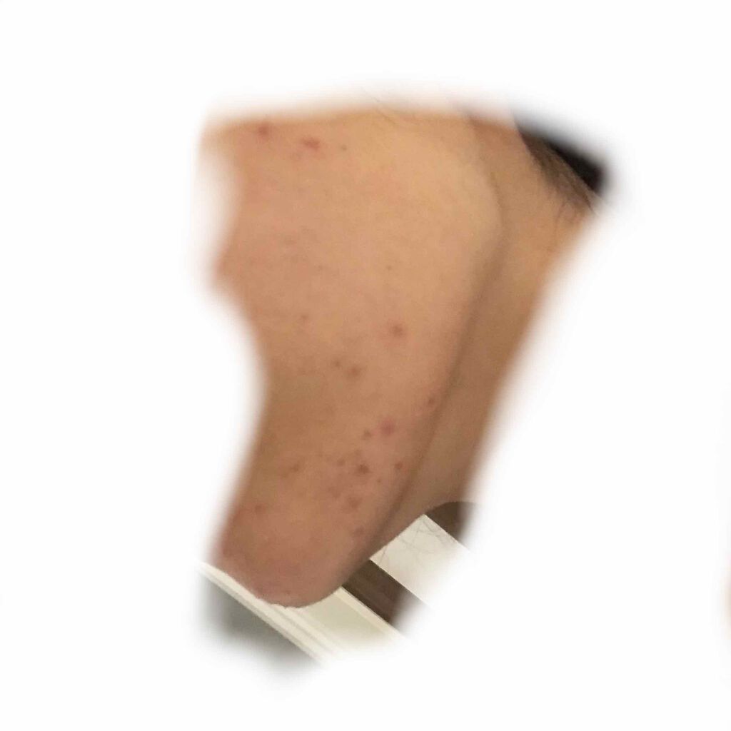 ペアアクネクリームW(医薬品)/ペア/その他を使ったクチコミ(2枚目)