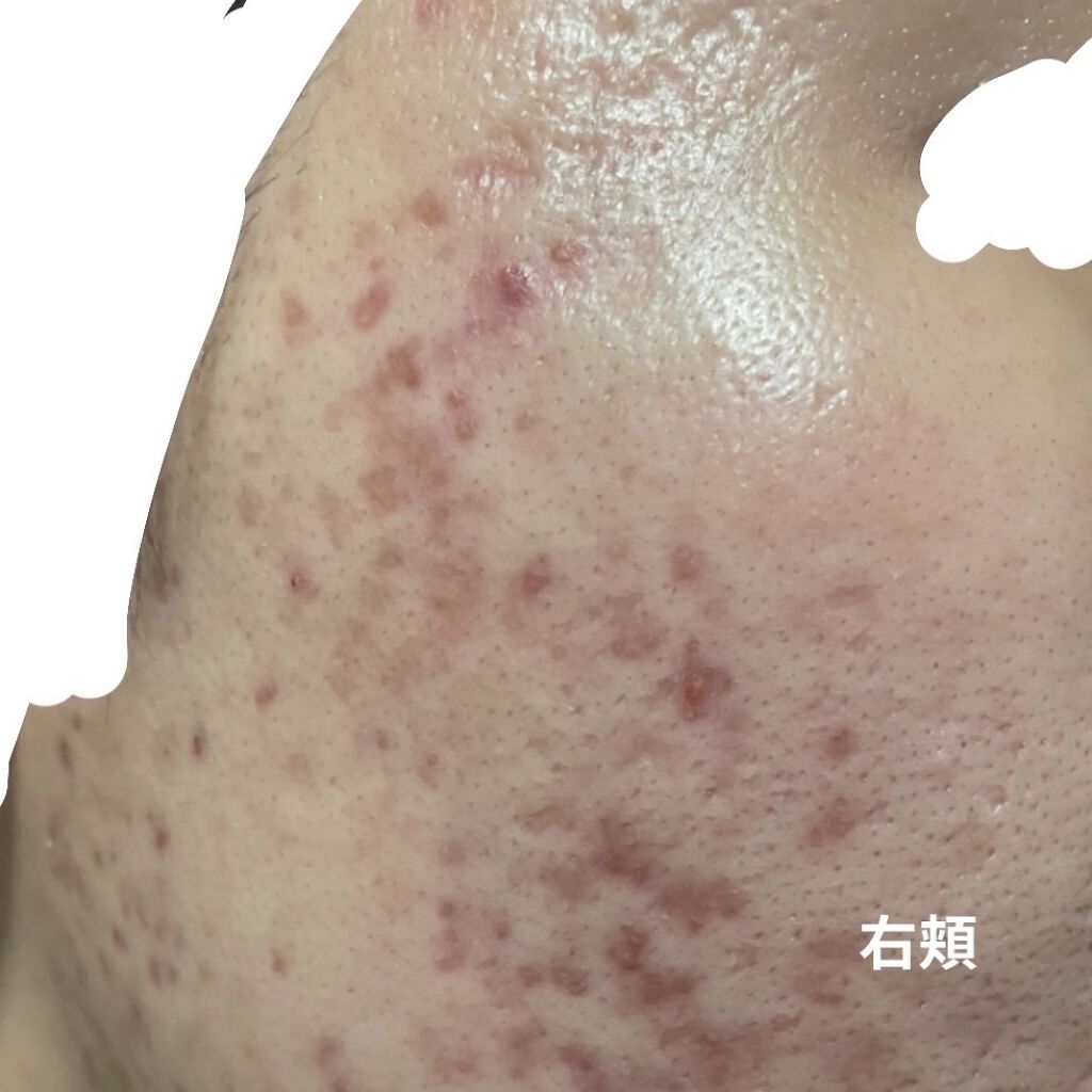 モイスチャー 1セット/エンビロン/トライアルキットを使ったクチコミ（2枚目）