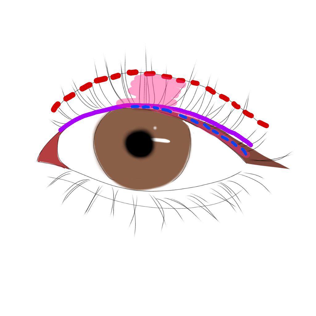 ダブルアイリッド/DAISO/二重まぶた用アイテムを使ったクチコミ（3枚目）