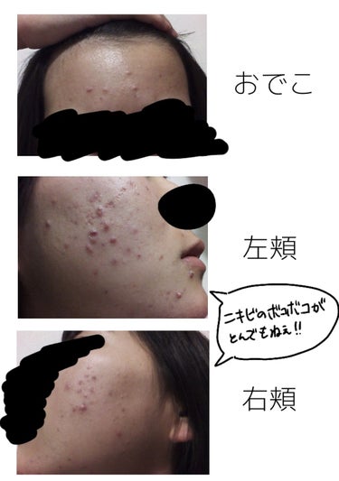 メラノCC 薬用しみ対策 美白化粧水のクチコミ「
ほんとにニキビ跡酷いね(笑)

────

汗ちゃんだよ～！初投稿だよ～！
上の煽り文はアタ.....」（2枚目）