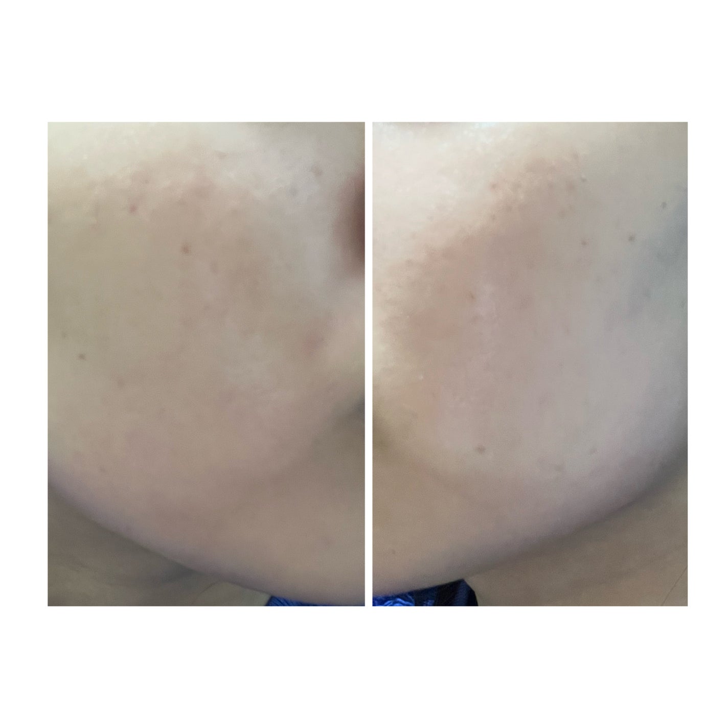 ぽむ on LIPS 「2023.9.13皮膚科に受診 エピデュオとヘパリン処方1枚目..」(4枚目)