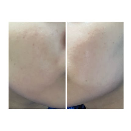 ぽむ on LIPS 「2023.9.13皮膚科に受診 エピデュオとヘパリン処方1枚目..」(4枚目)