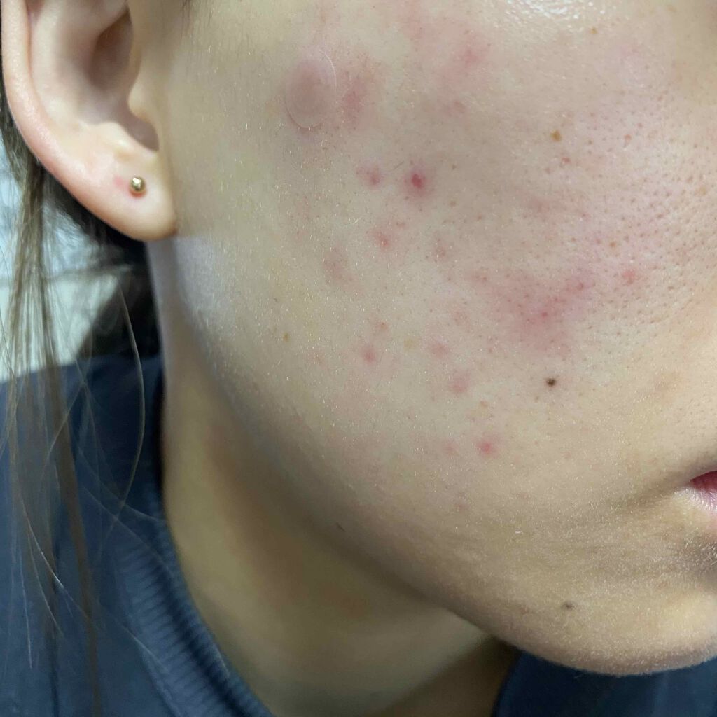 ゼビアックス(医薬品)/マルホ株式会社/その他を使ったクチコミ（1枚目）