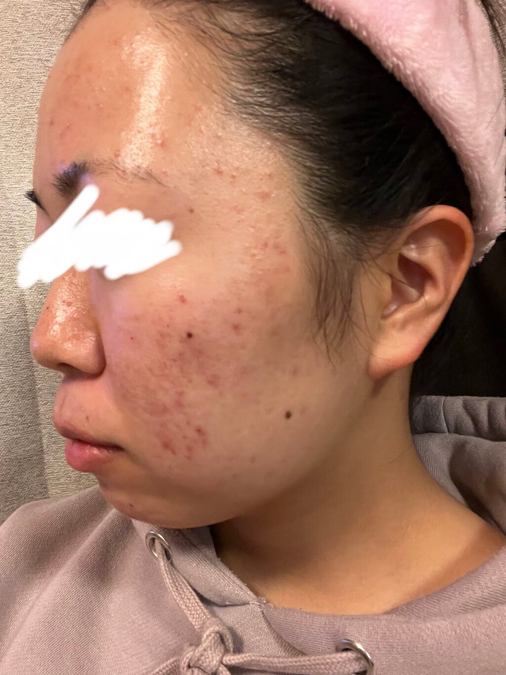 じゃがりこ@サラダ on LIPS 「お久しぶりです。今日は私が皮膚科に行った時の話をしたいと思いま..」(3枚目)