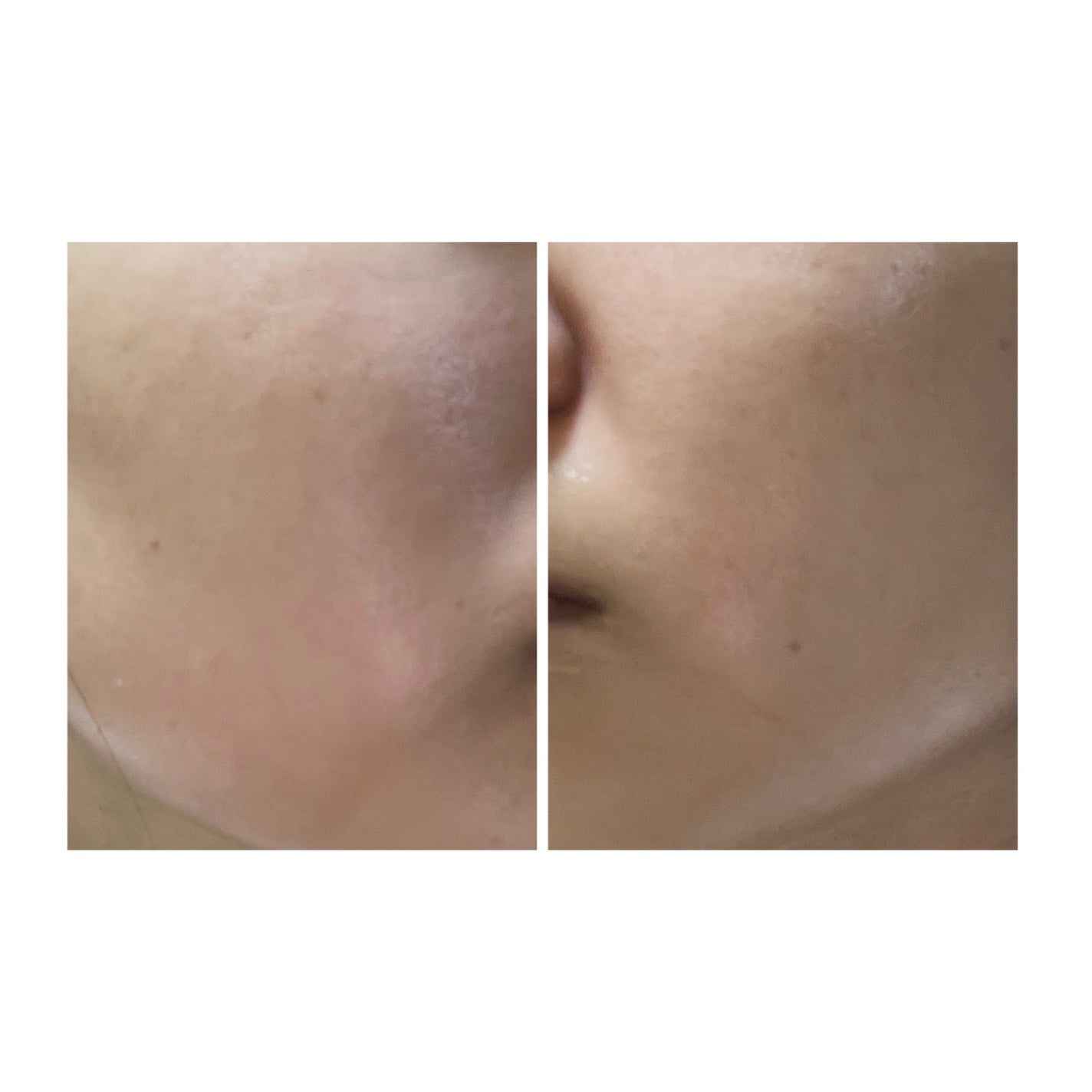 ぽむ on LIPS 「2023.9.13皮膚科に受診 エピデュオとヘパリン処方1枚目..」(5枚目)