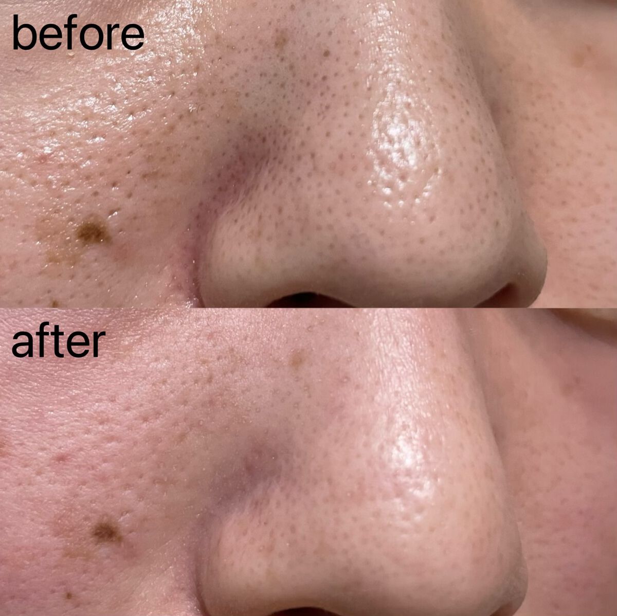 ノーモアブラックヘッド(ノーズピーリング)/One-day's you/スクラブ・ゴマージュを使ったクチコミ(3枚目)