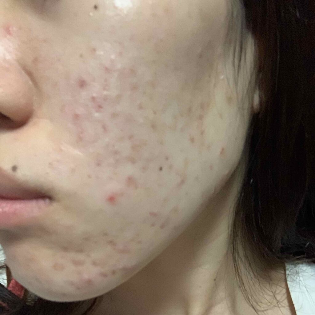 colorful_lips_kz1t on LIPS 「ニキビが酷すぎて悩んでいます。赤ニキビ、白ニキビ、小さいブツブ..」(2枚目)