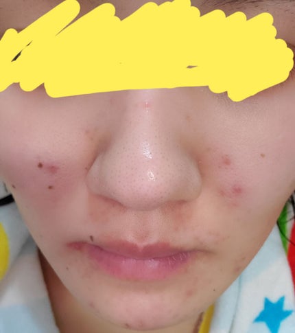 タカミスキンピール/タカミ/ブースター・導入液を使ったクチコミ(2枚目)