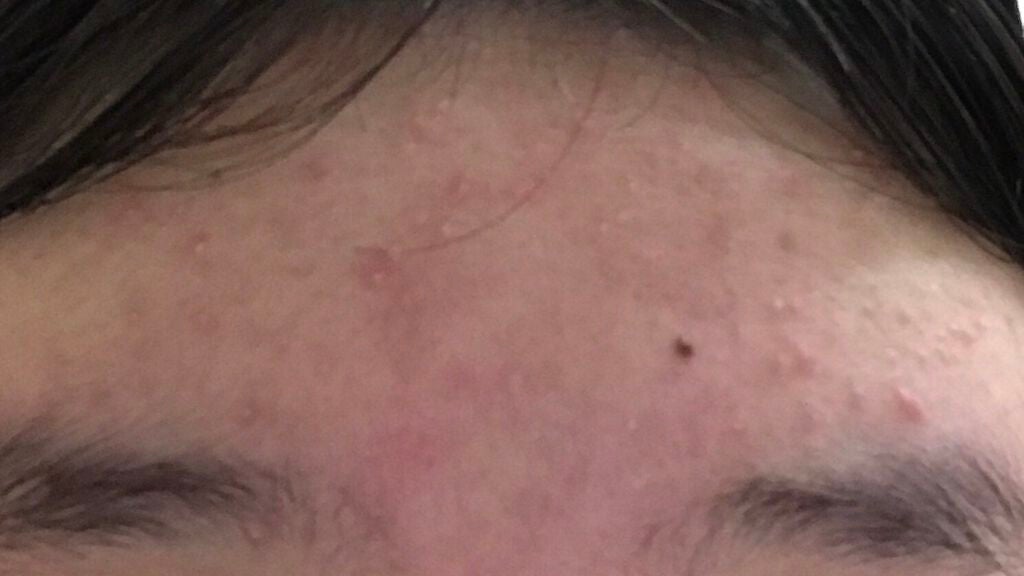 りこ on LIPS 「やほー!今日も汚い肌見ていってぇぇぇぇぇぇぇぇぇぇぇぇ!..」(1枚目)