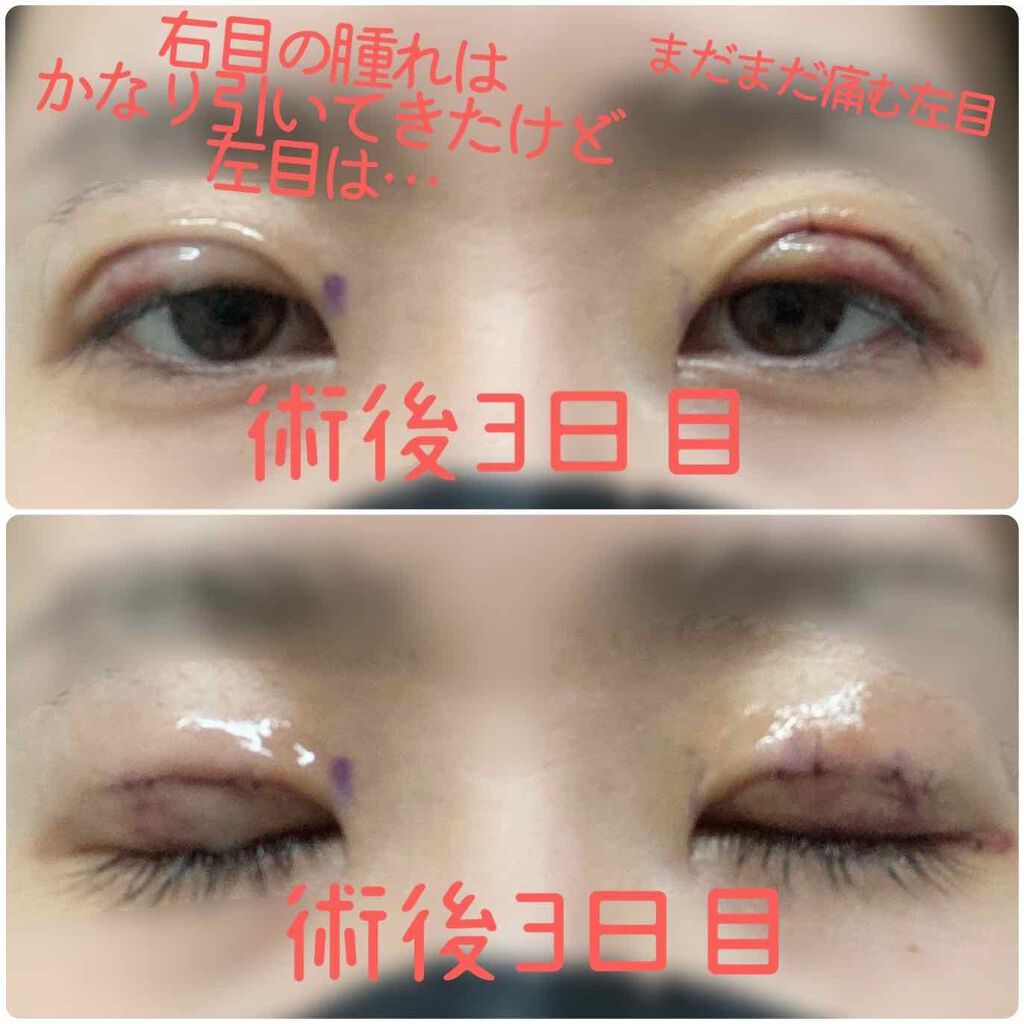fantastic_blush_7x5 on LIPS 「こんばんは。二重手術(部分切開法・小切開法)の経過報告3です。..」(4枚目)