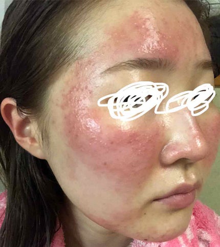 ベピオゲル/マルホ株式会社/その他を使ったクチコミ(2枚目)