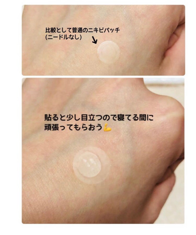 トラブルケアパッチ/大熊製薬/にきびパッチを使ったクチコミ(4枚目)