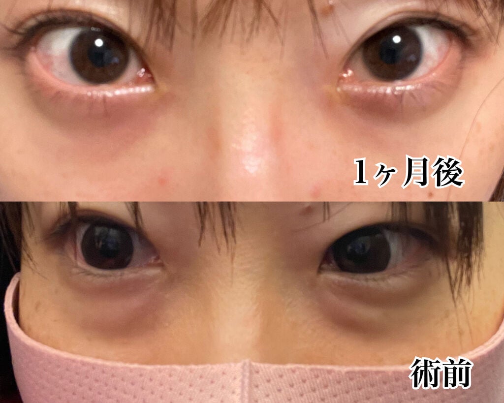 【旧】ディオールスキン フォーエヴァー スキン コレクト コンシーラー/Dior/リキッドコンシーラーを使ったクチコミ(6枚目)