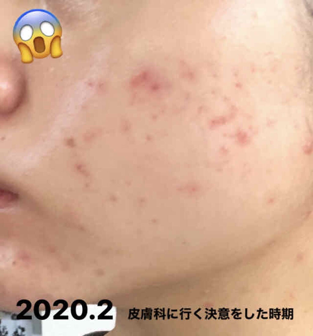 **むぎちゃん** on LIPS 「なぜ私が肌荒れしたのかおはようございます☀︎私自身、自分の肌荒..」(3枚目)