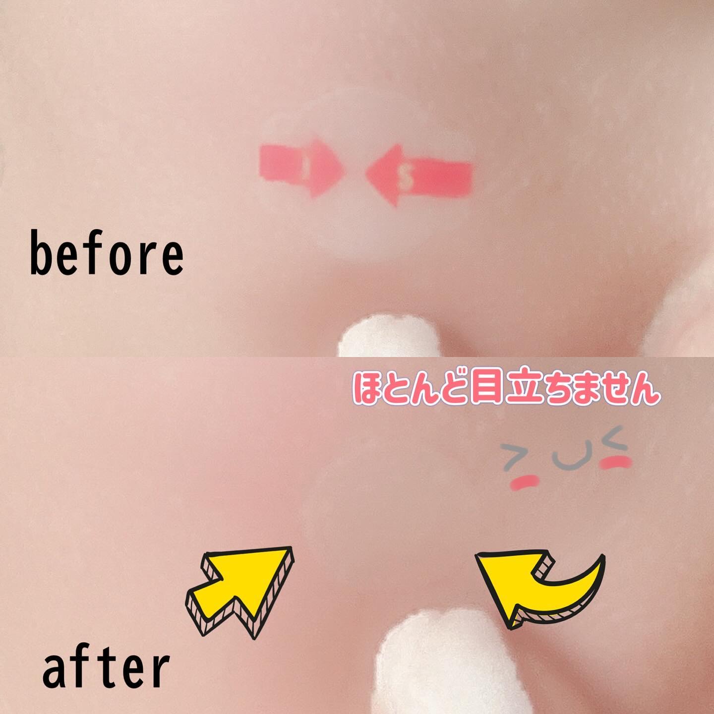 キャッチミーパッチ/CATCH ME PATCH/にきびパッチを使ったクチコミ（3枚目）