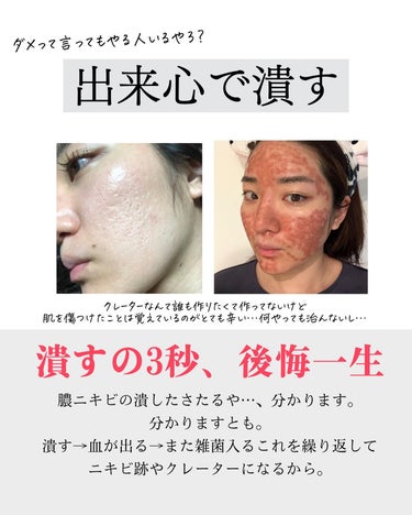 おゆみ|ニキビ・ニキビ跡ケア on LIPS 「【ニキビ歴２０年の私が、最初に知っておきたかったこと】✔︎ニキ..」（3枚目）