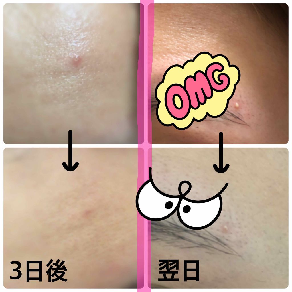 ペアアクネクリームW(医薬品)/ペア/その他を使ったクチコミ（2枚目）