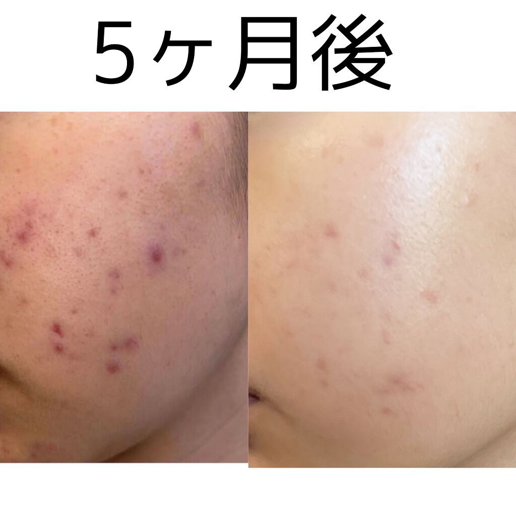 モイスチャライジングローション/エトヴォス/化粧水を使ったクチコミ（1枚目）