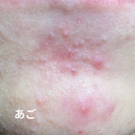 ãªãð± on LIPS ããããã»ãããè·¡ãæ²»ããã髿 ¡çã§ã!!ãã1幎ã§èããã®ãã..ãïŒ4æç®ïŒ