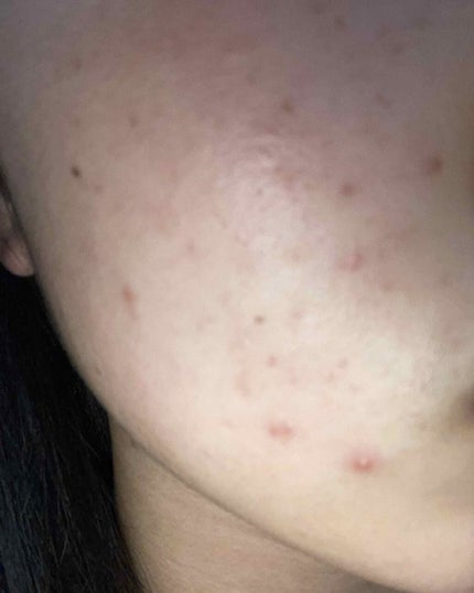 ぴよこ on LIPS 「肌断食3日目!頬は変化なし!眉間にニキビができました😭まだまだ..」(4枚目)