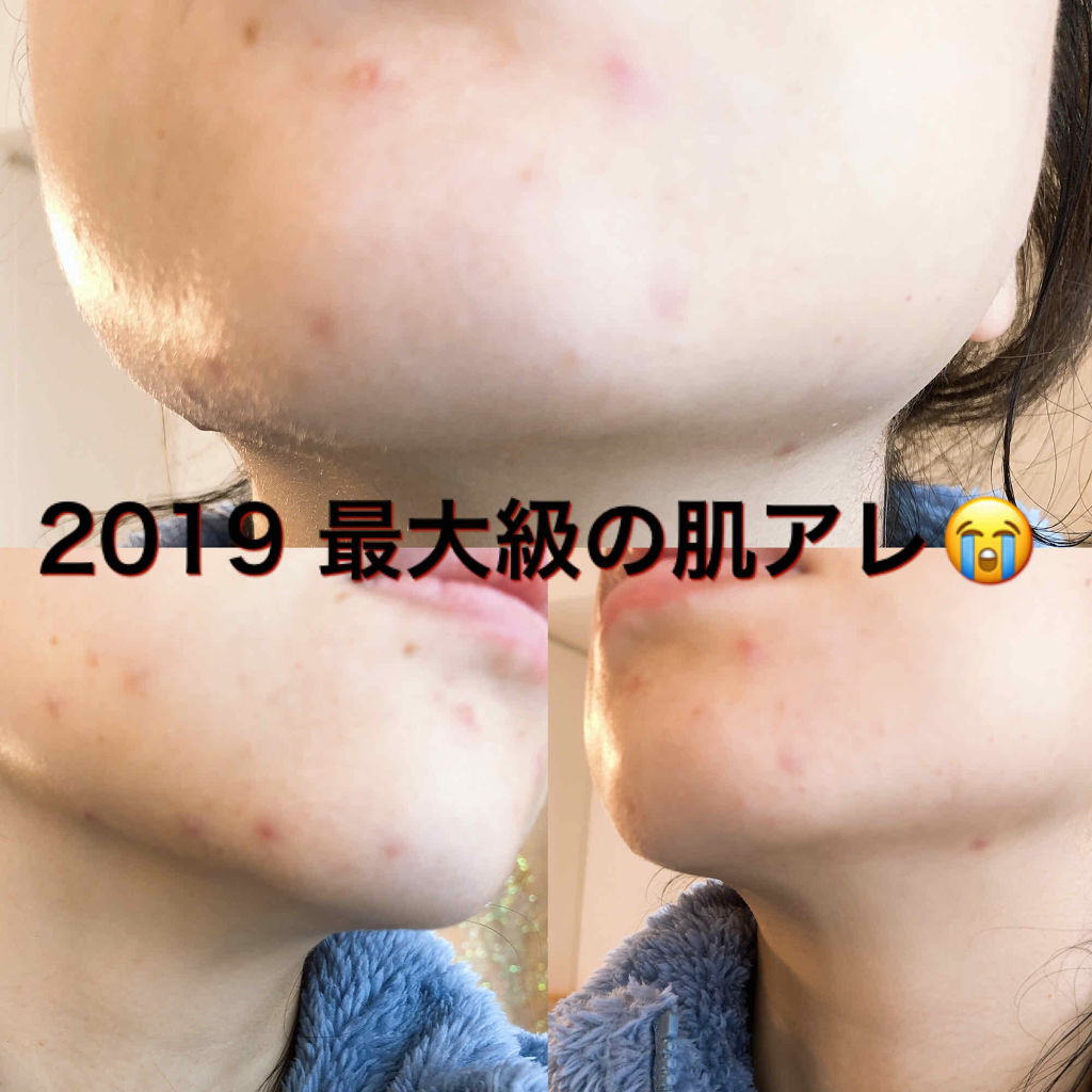 シカ スポットパッチ/Lovelycos /シートマスク・パックを使ったクチコミ（2枚目）