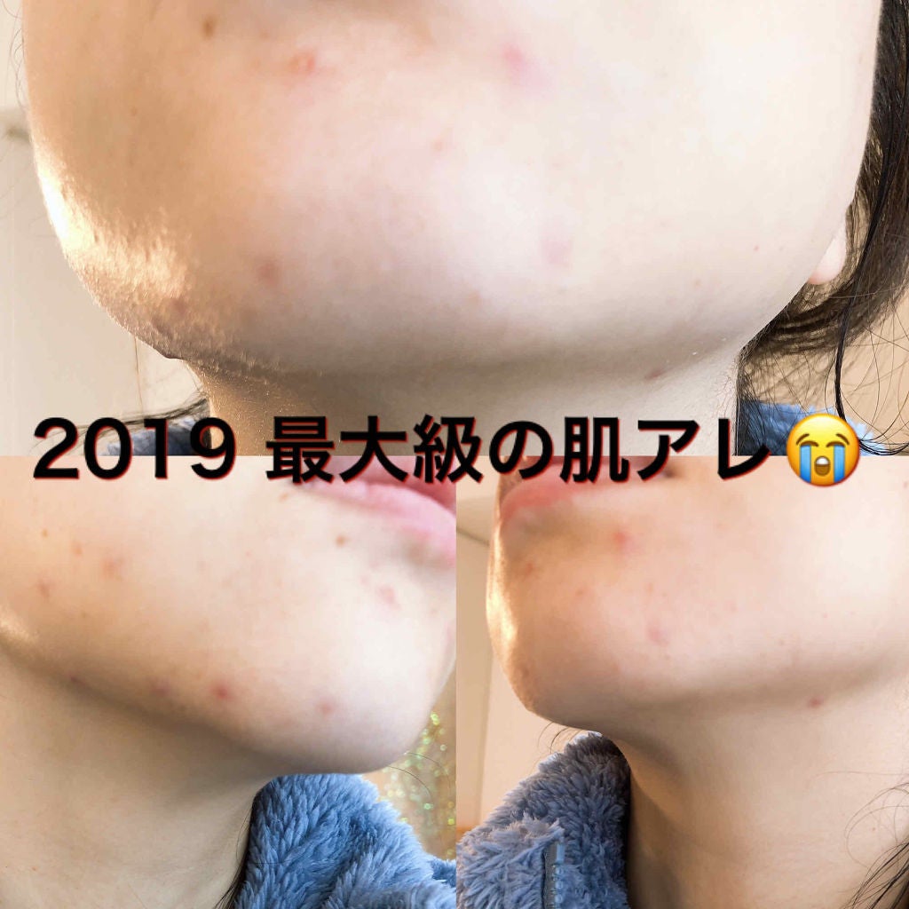 シカ スポットパッチ/Lovelycos /シートマスク・パックを使ったクチコミ(2枚目)