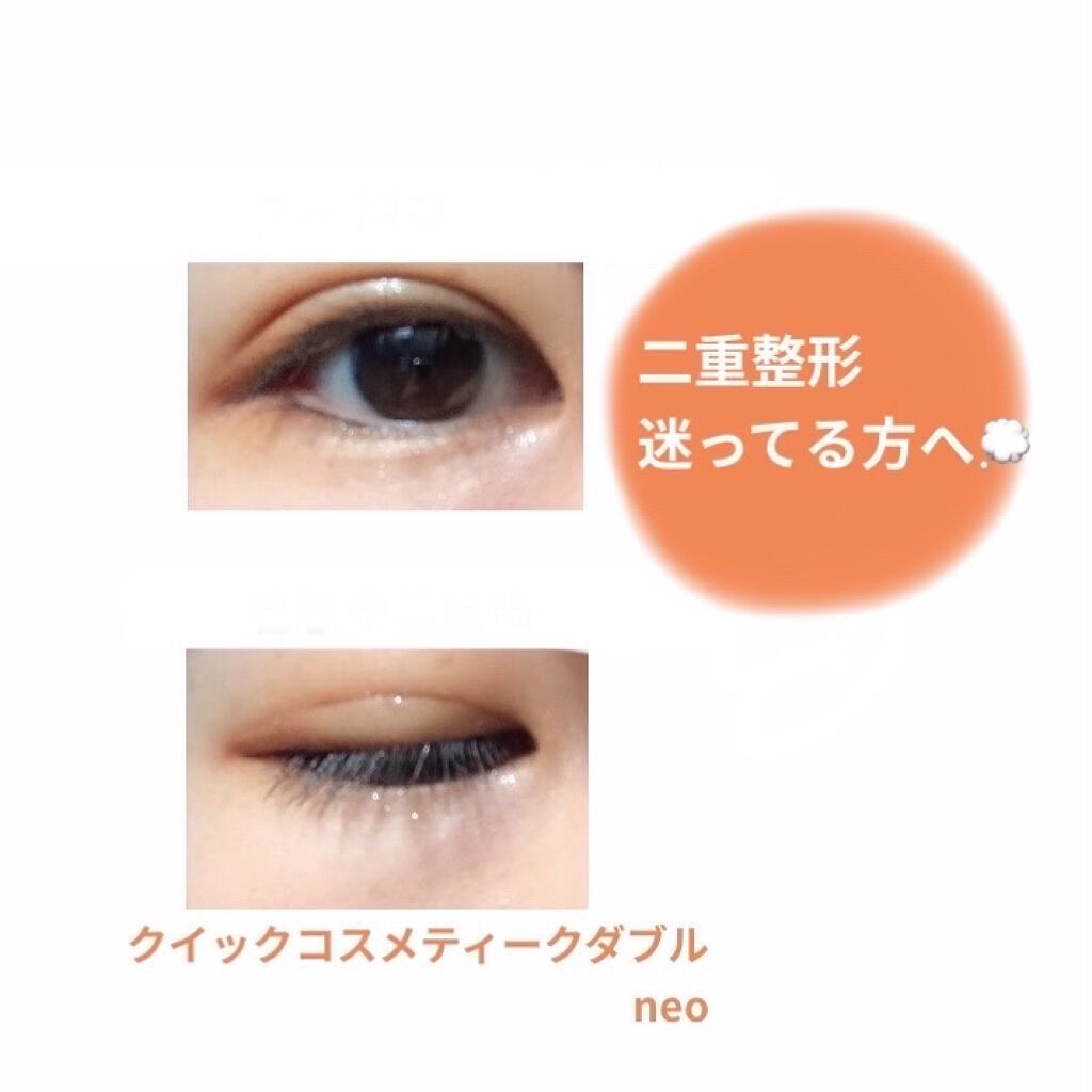 二重整形/その他を使ったクチコミ（1枚目）