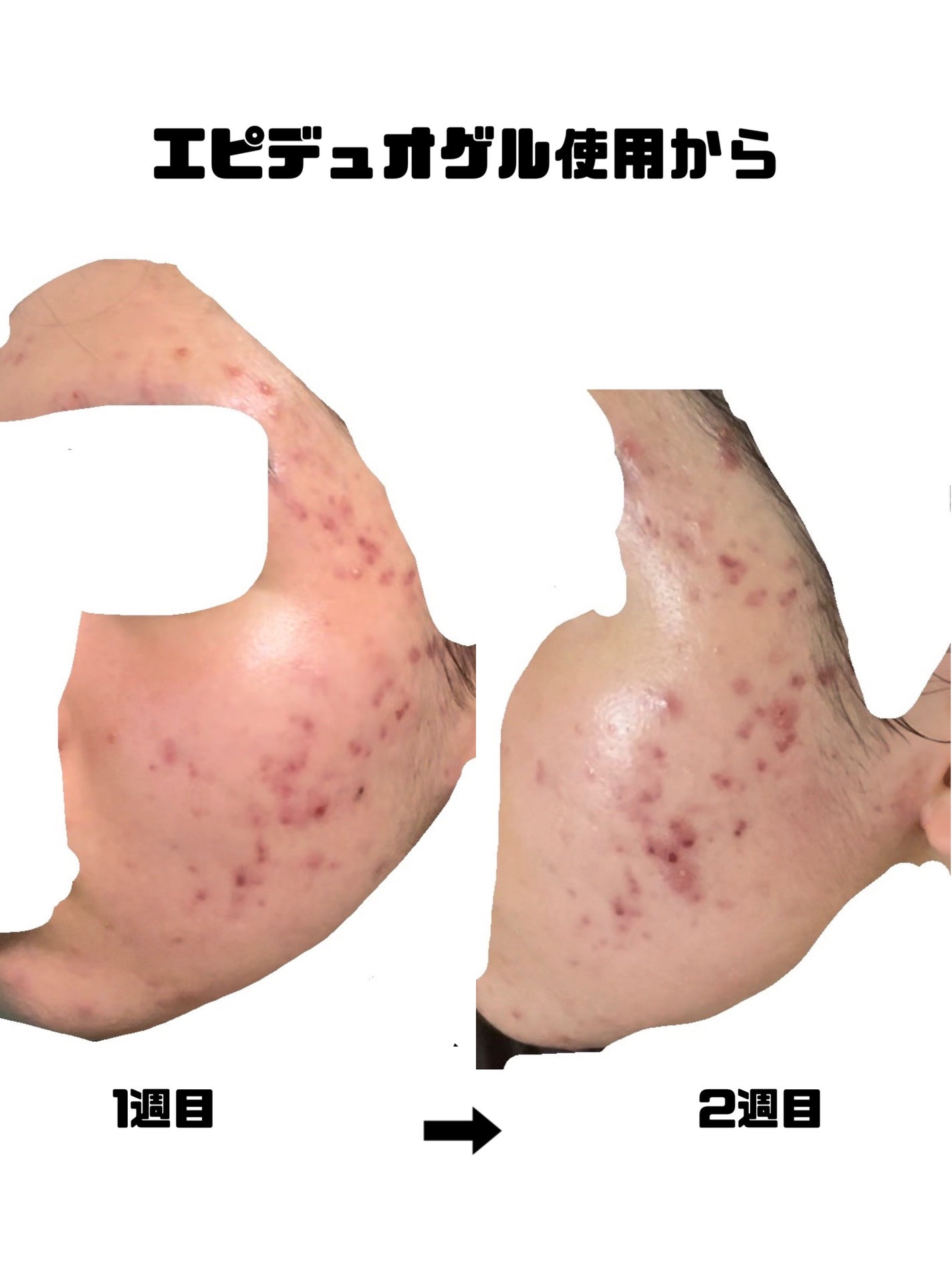 みこ on LIPS 「【治療経過】閲覧注意です!エピデュオゲルを使い始めてから2週間..」(3枚目)