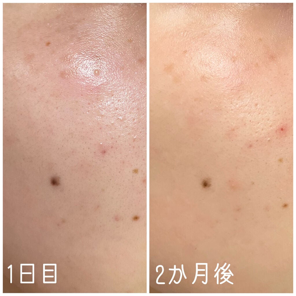 ミラミン/ZO Skin Health/フェイスクリームを使ったクチコミ(9枚目)