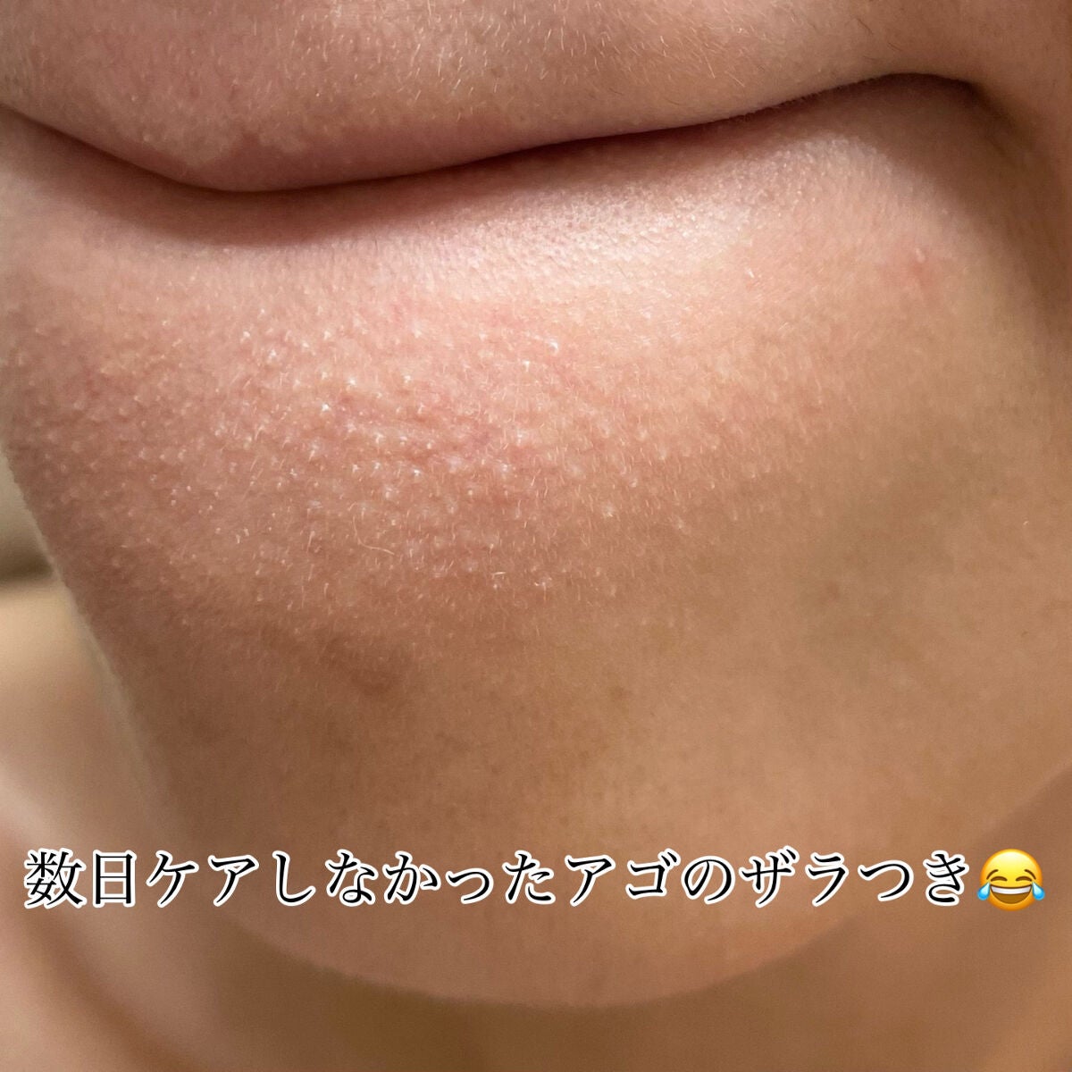 アクレオンセボエクストラクター/ANACIS/その他スキンケアを使ったクチコミ(4枚目)