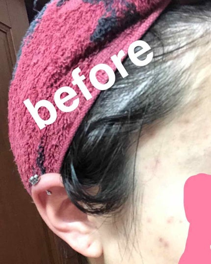 バイオイル/バイオイル/フェイスオイルを使ったクチコミ(2枚目)