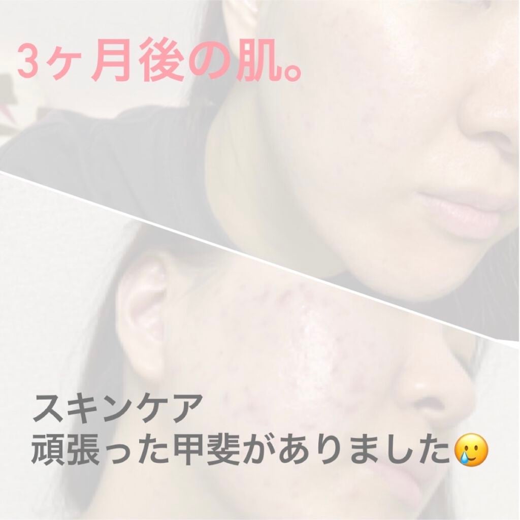 A アクネフォーム/NOV/洗顔フォームを使ったクチコミ(1枚目)