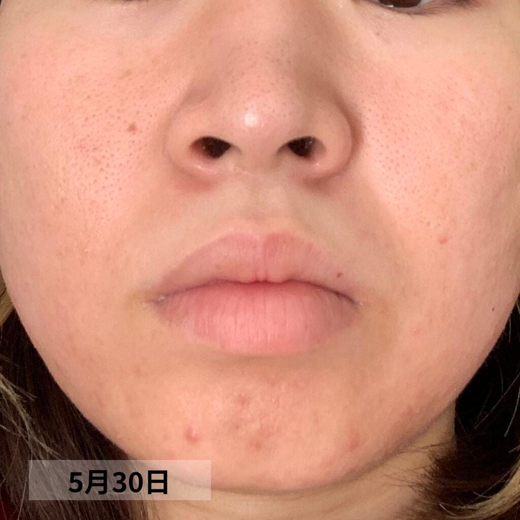 PURE ROSEHIP SEED OIL/Life-flo/フェイスオイルを使ったクチコミ(9枚目)