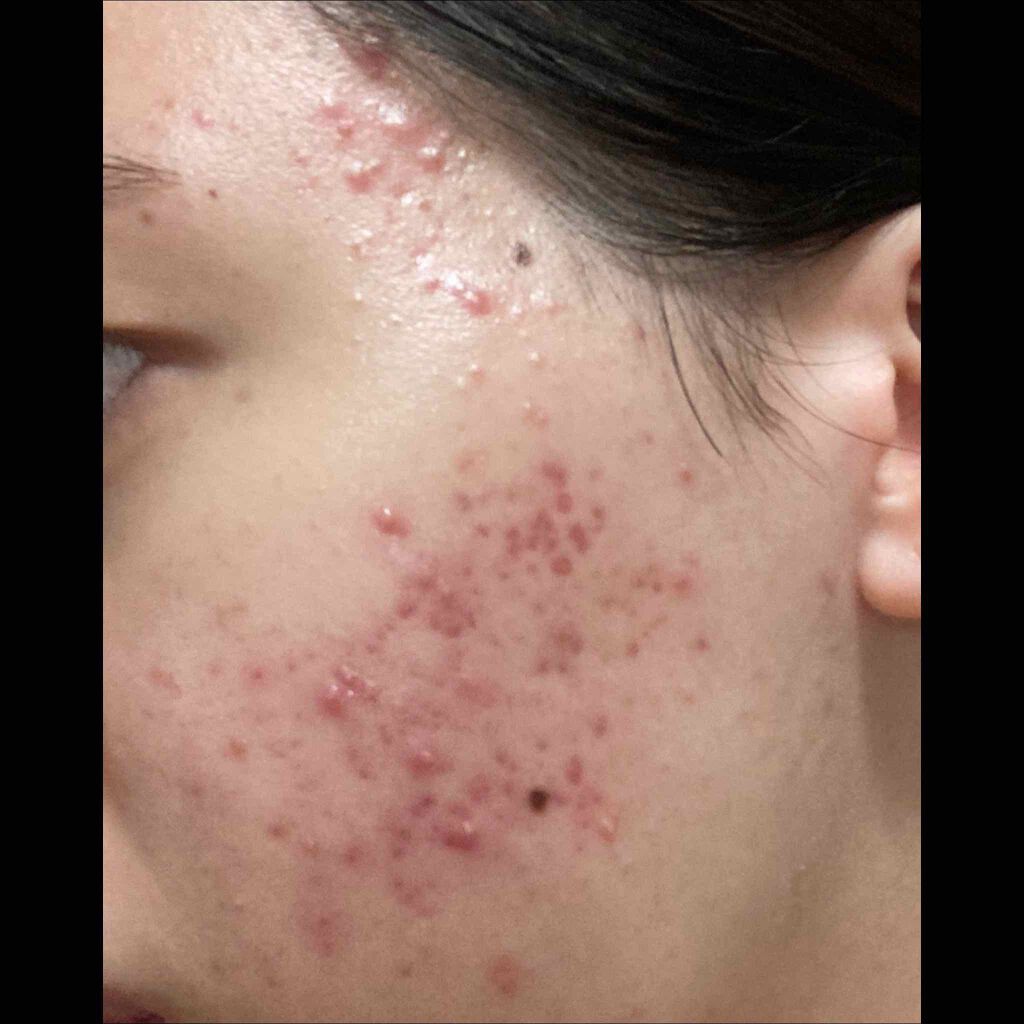 ミノン アミノモイスト 敏感肌・混合肌ライン トライアルセット/ミノン/トライアルキットを使ったクチコミ（1枚目）