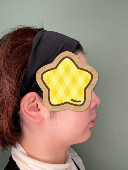 め@フォロバします on LIPS 「顎プロテーゼをやって半年経ったので記録。写真は術前1週間後1ヶ..」(4枚目)