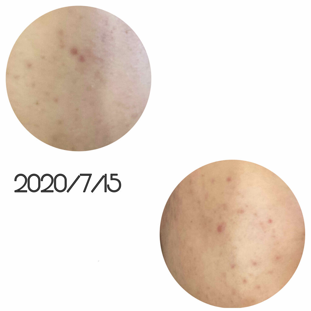 薬用しみ対策 美白化粧水/メラノCC/化粧水を使ったクチコミ（2枚目）