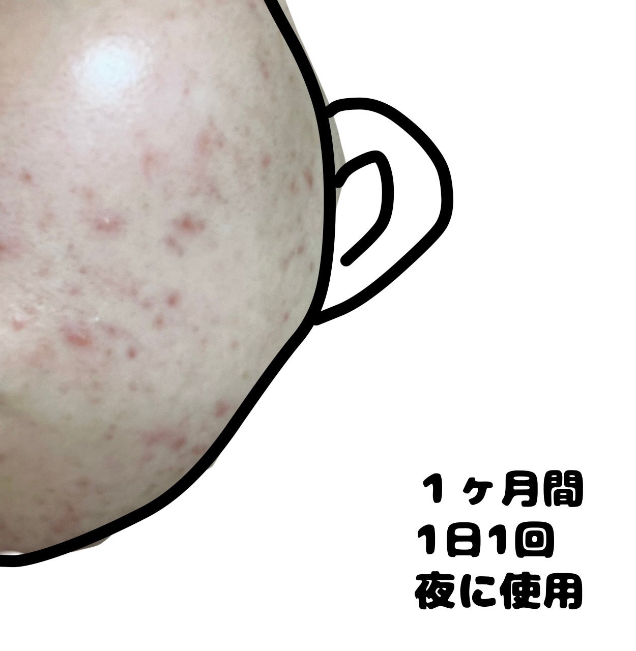 薬用しみ集中対策 プレミアム美容液/メラノCC/美容液を使ったクチコミ(4枚目)