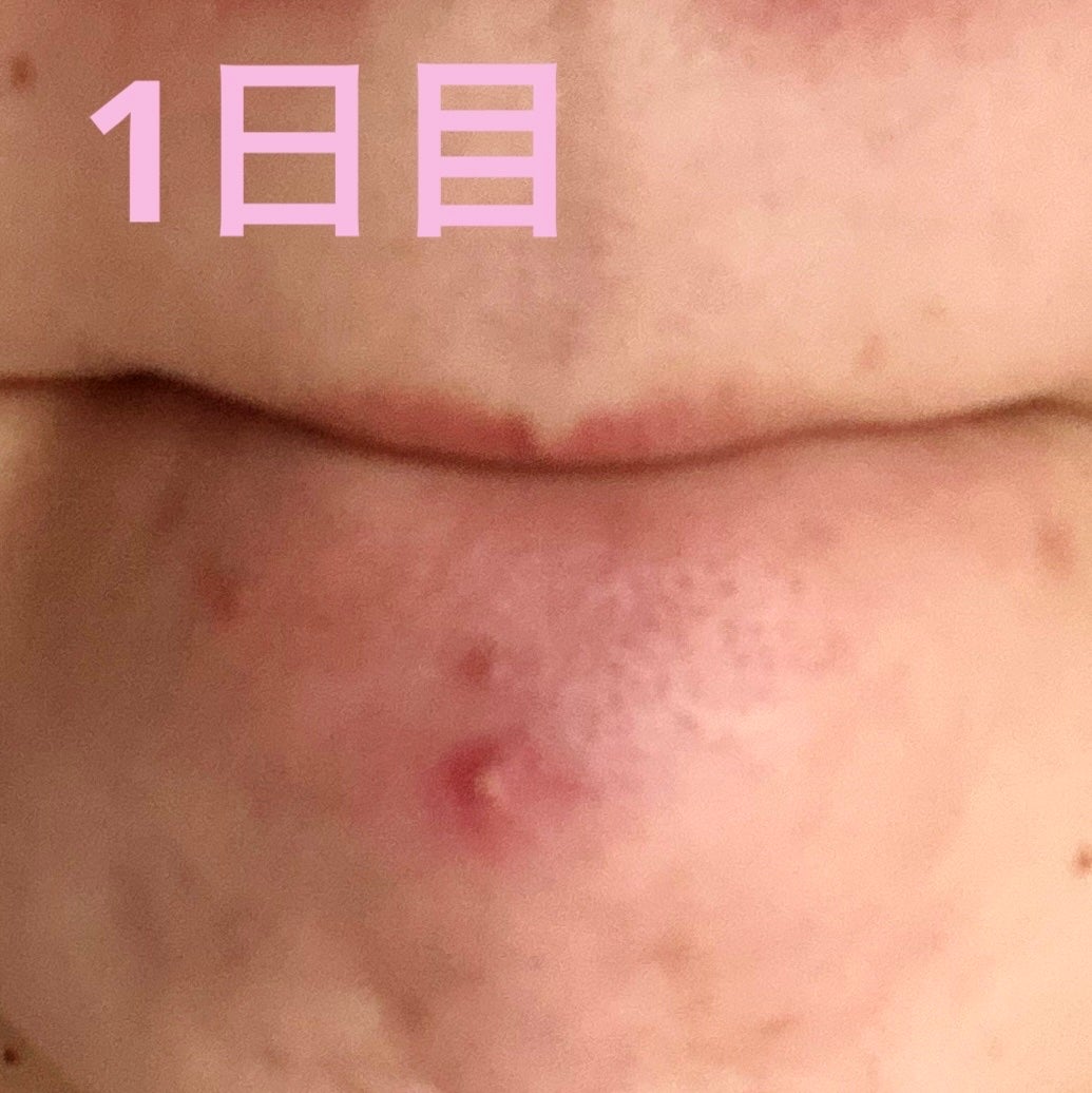 プロCICA クリアスポットパッチ/VT/その他スキンケアを使ったクチコミ(5枚目)