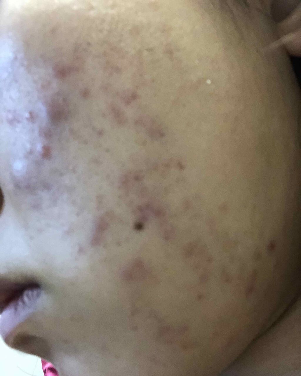 Lisa on LIPS 「肌荒れ酷すぎて困ってますLIPSの記事もたくさん見て、ネットで..」(2枚目)