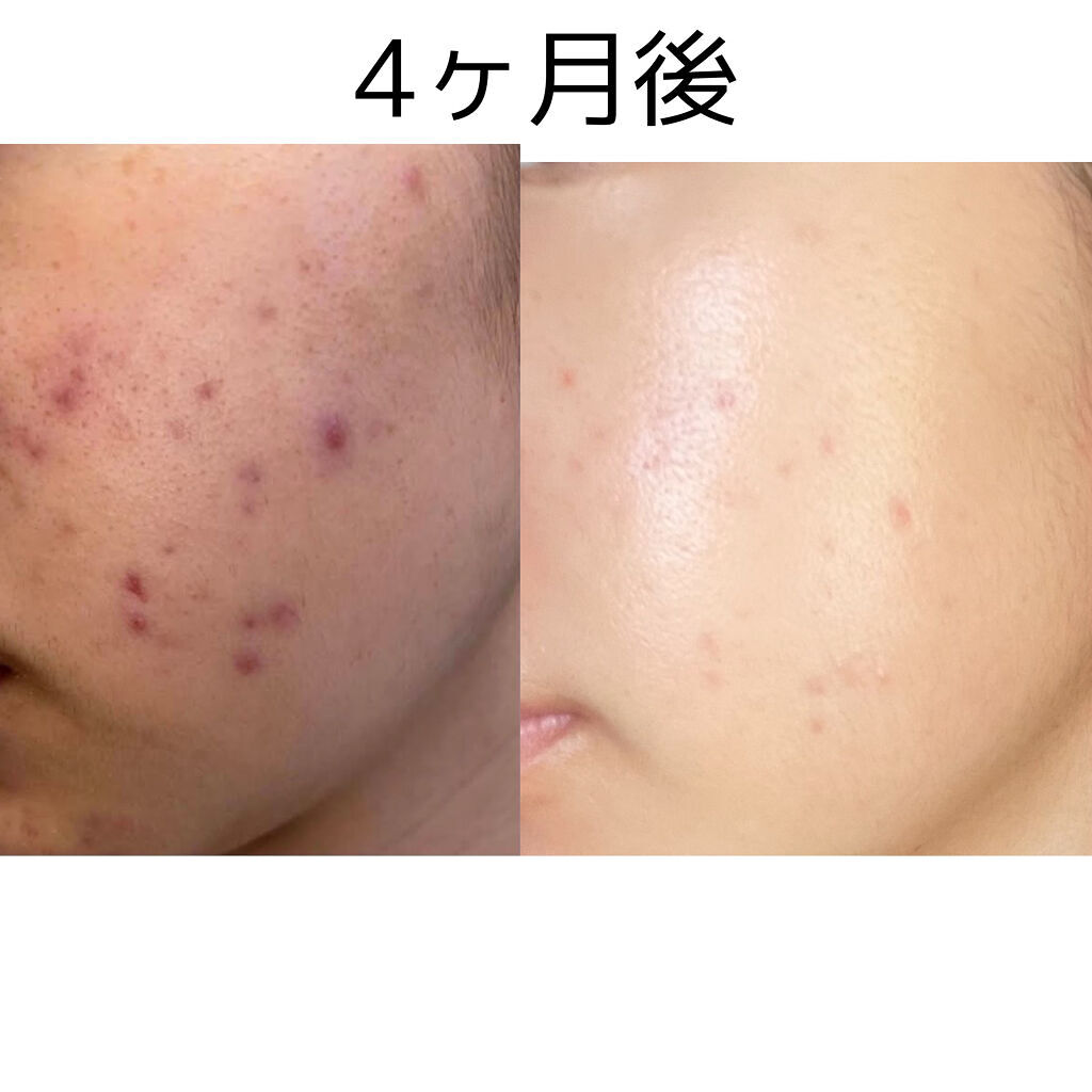 潤浸保湿 化粧水 III とてもしっとり/キュレル/化粧水を使ったクチコミ（1枚目）